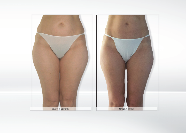 Endermolift LPG efekty